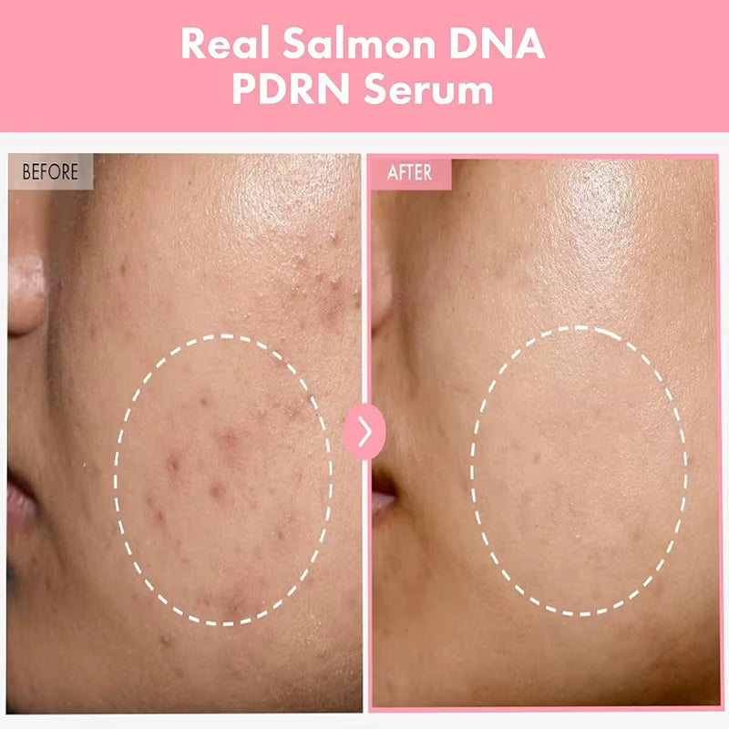 Korean Skincare Complex Peptide Acne Serum with PDRN Collagen - Pore Shrinking Melanin Fading Skin Brightening and Smoothing