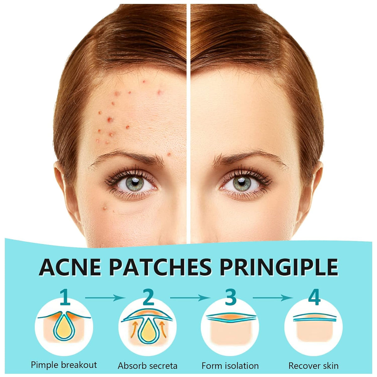 180 Counts Pimple Patches for Face 